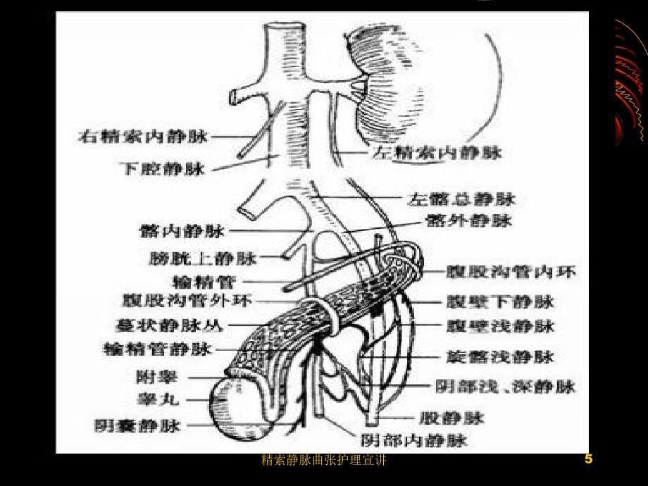 精索静脉曲张护理宣讲培训课件_第5页