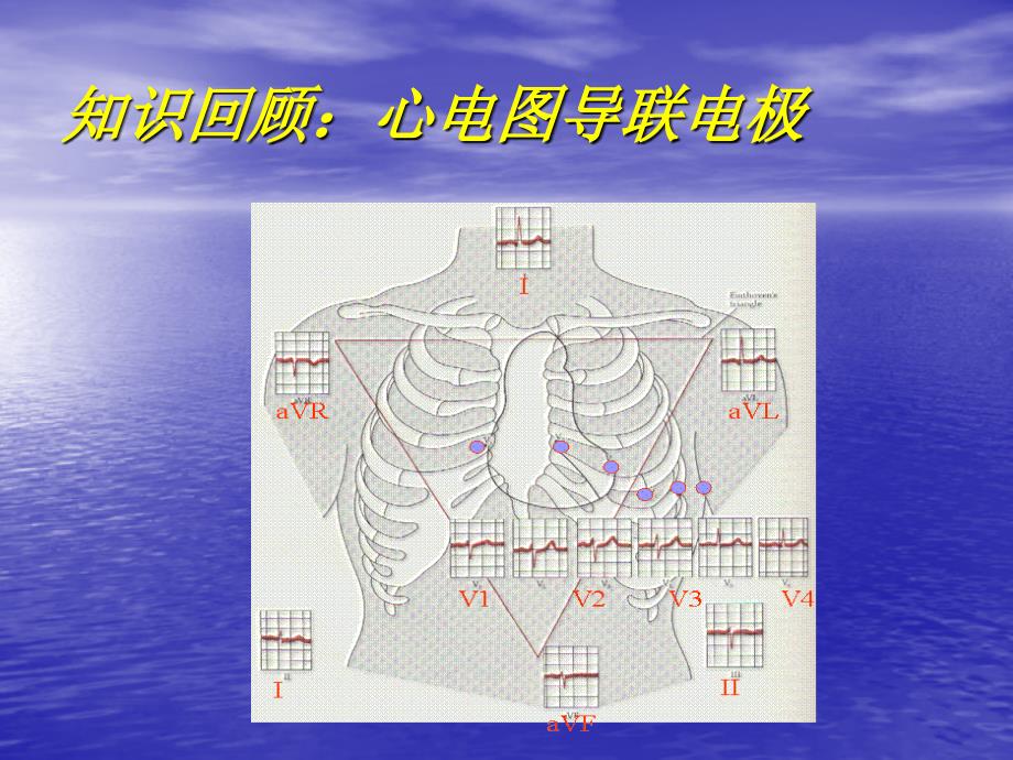 常见心脏疾病心电图诊断_第3页