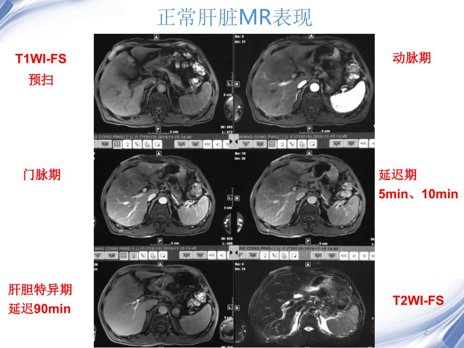 肝脏的MR表现优秀课件_第2页