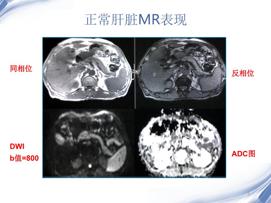 肝脏的MR表现优秀课件_第3页