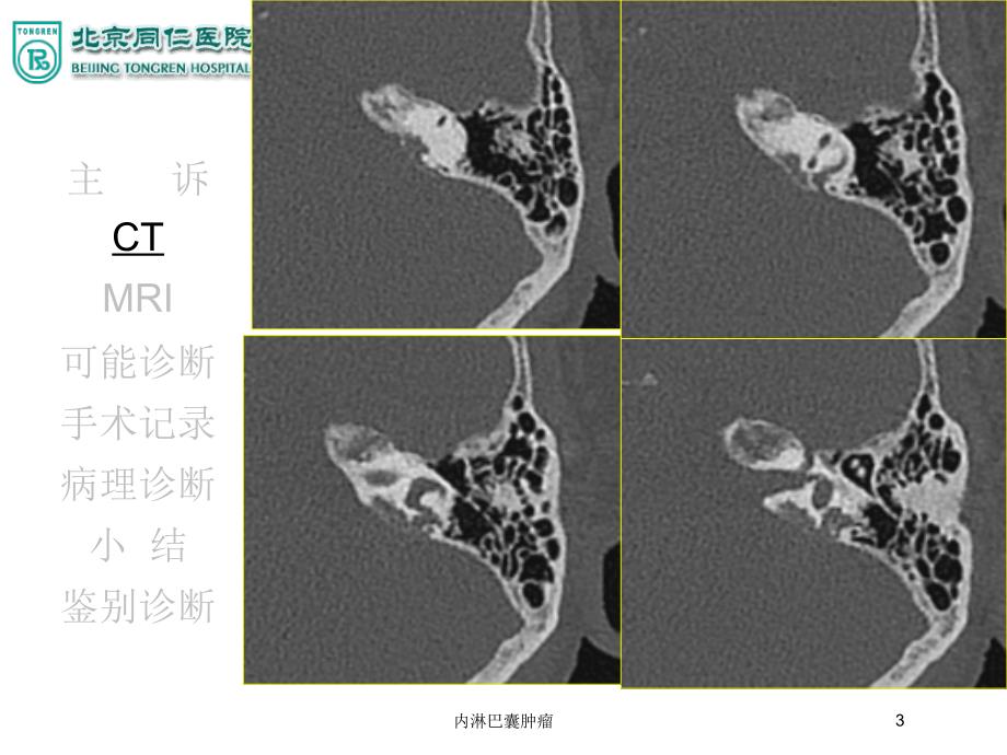 内淋巴囊肿瘤培训课件_第3页