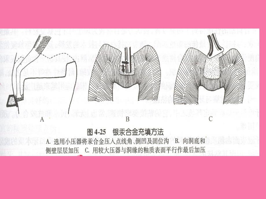 充填材料玻璃离子ppt课件_第2页