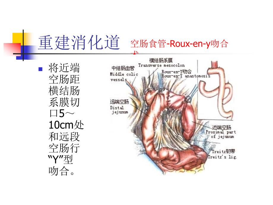 图解全胃切除术_第2页