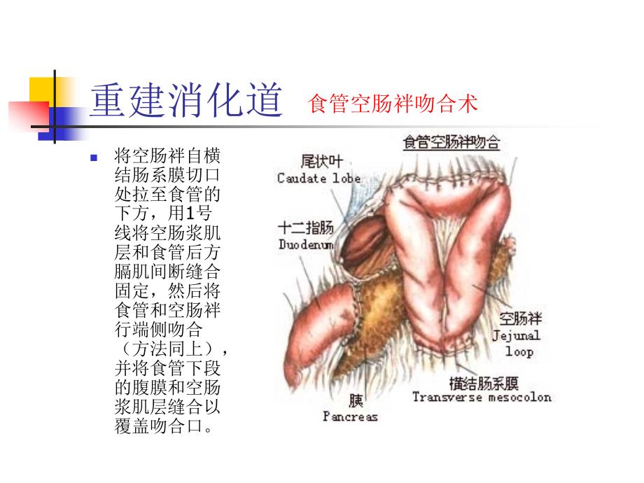 图解全胃切除术_第4页