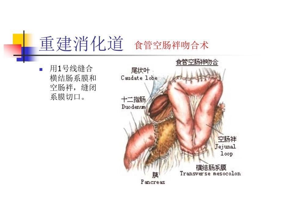 图解全胃切除术_第5页