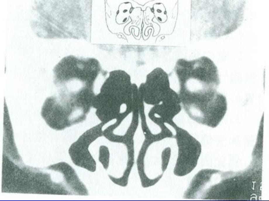 官及颈胸部疾病的CT诊断_第5页