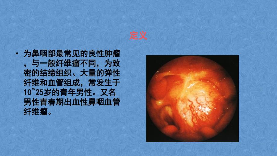 耳鼻咽喉头颈外科学鼻咽癌_第4页