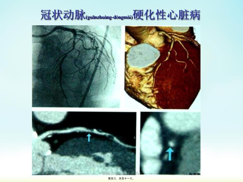 第四节-后天性心脏病I课件_第5页