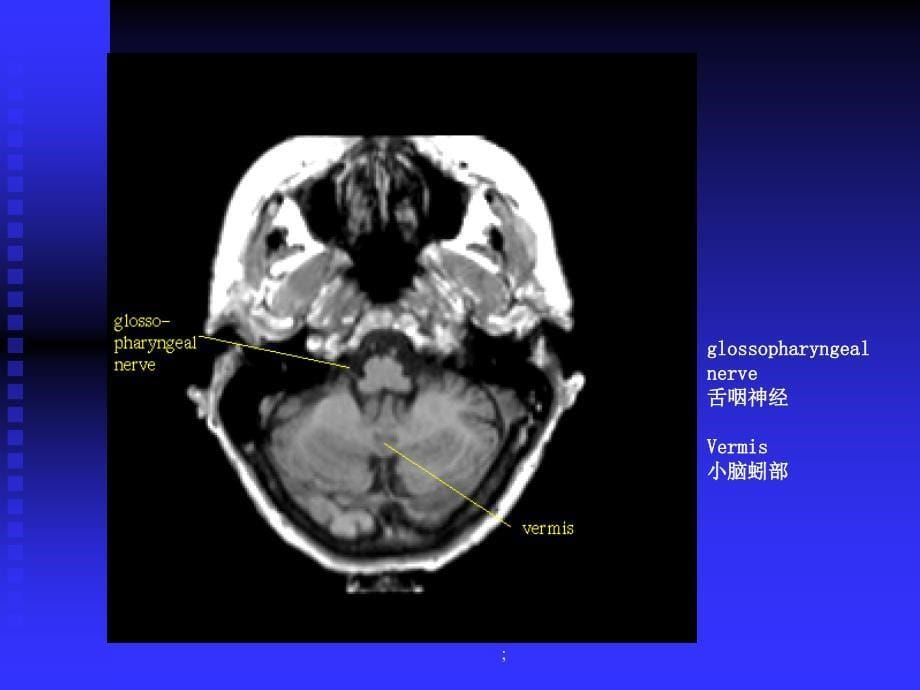 神经学解剖影像ppt课件_第5页