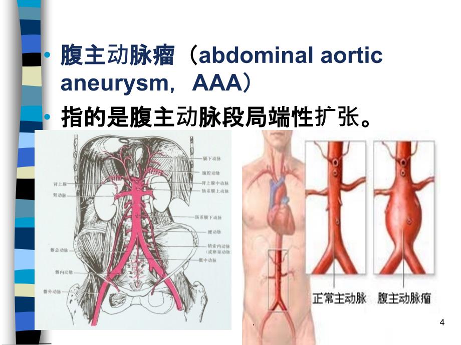 腹主动脉瘤的护理PPT课件_第4页