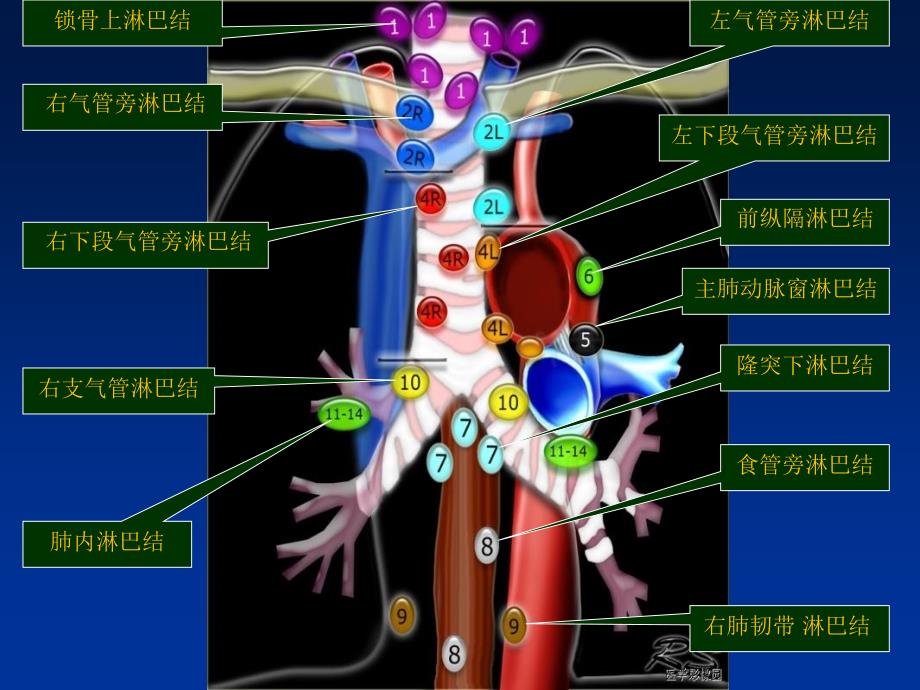 肺癌纵膈肺门淋巴结分区及CT图像_第3页