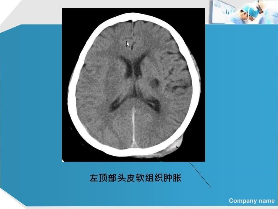 脑外伤的CT与MRI诊断_第5页