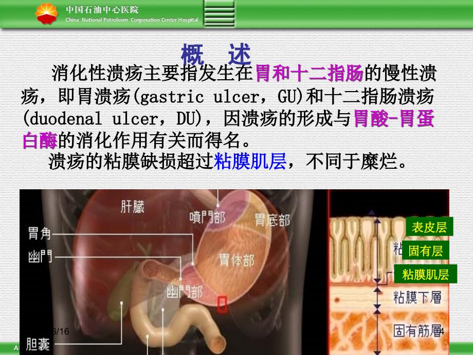 消化性溃疡讲课ppt_第4页