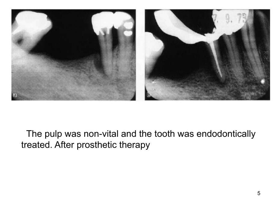 牙周牙髓联合病变PPT课件_第5页
