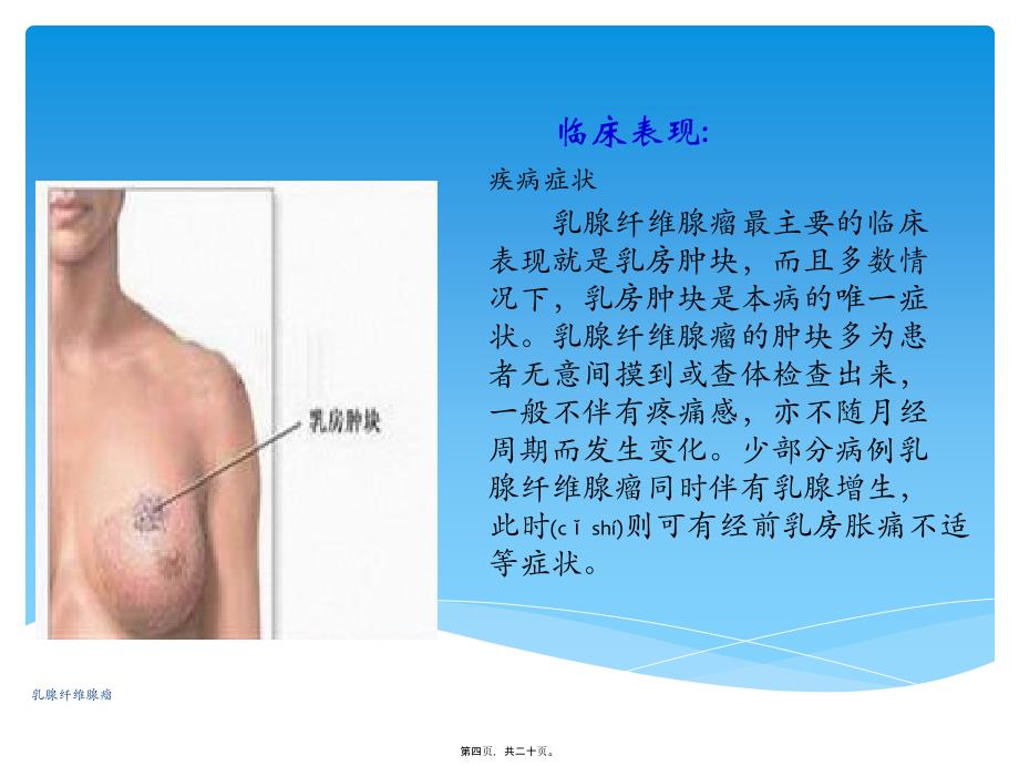 乳腺纤维腺瘤课件_第4页