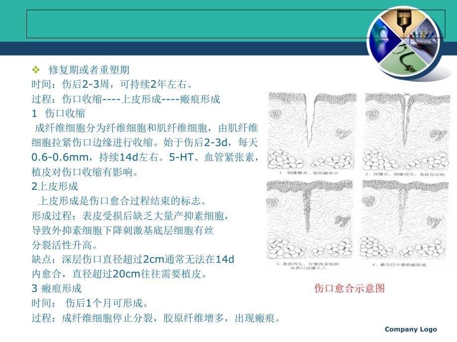 压疮的护理伤口的愈合演示稿_第5页