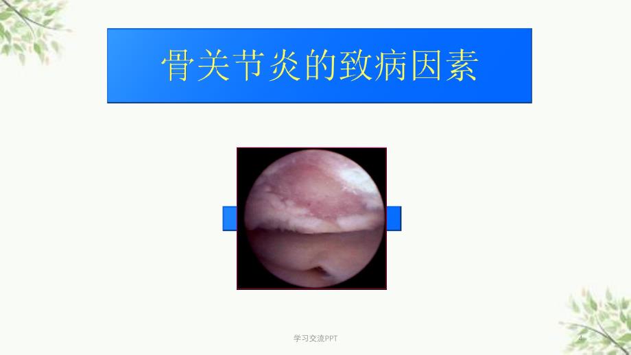 骨关节炎治疗医学课件_第4页