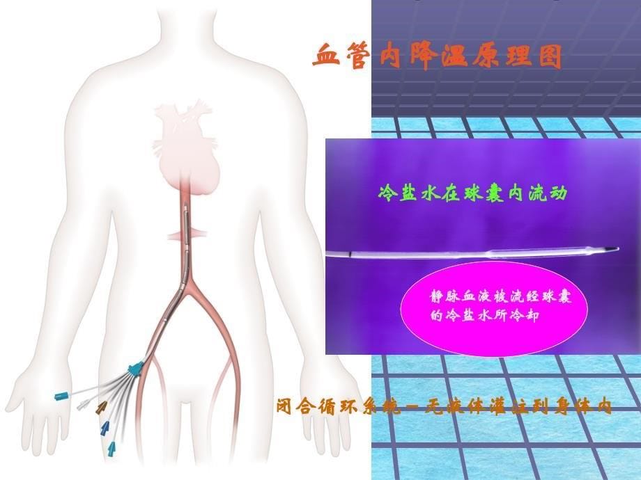 血管内途径降温治疗的临床研究xgppt课件_第5页