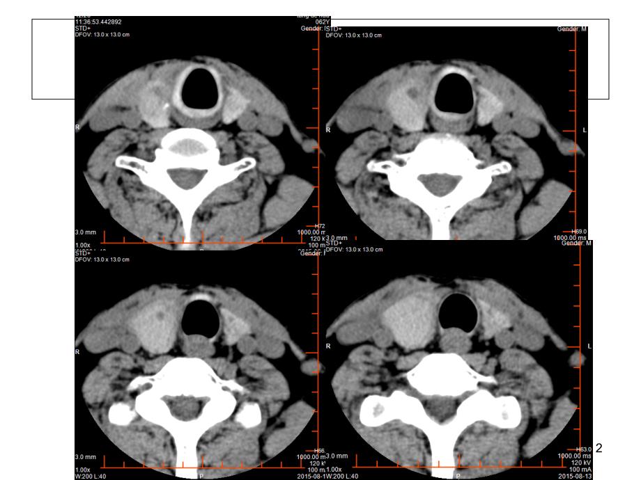 结节性甲状腺肿PowerPoint演示文稿_第2页