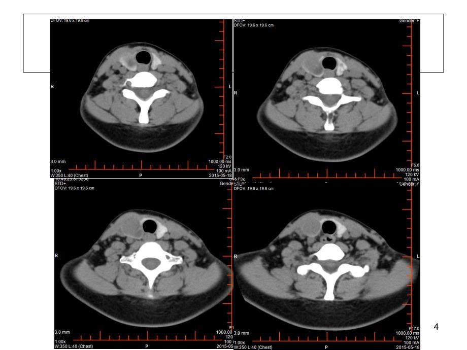结节性甲状腺肿PowerPoint演示文稿_第4页