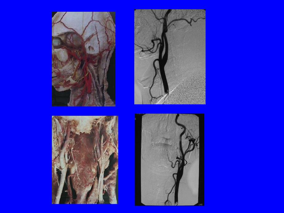 颈内动脉解剖PPT_第4页