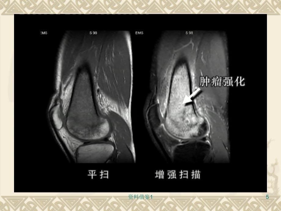骨关节病MRI诊断（行业荟萃）_第5页