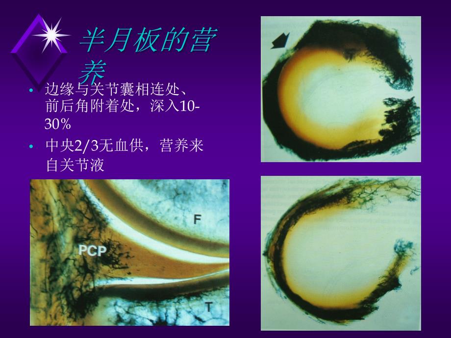 膝关节半月板损伤剖析课件_第4页