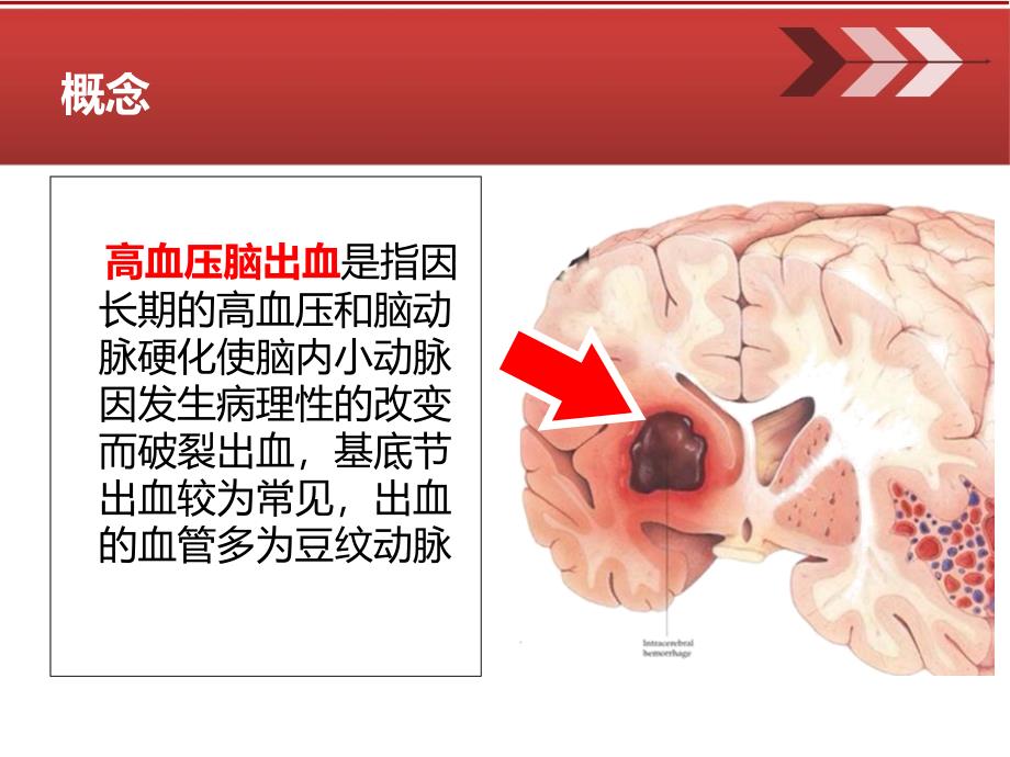 高血压脑出血围手术期护理_第4页