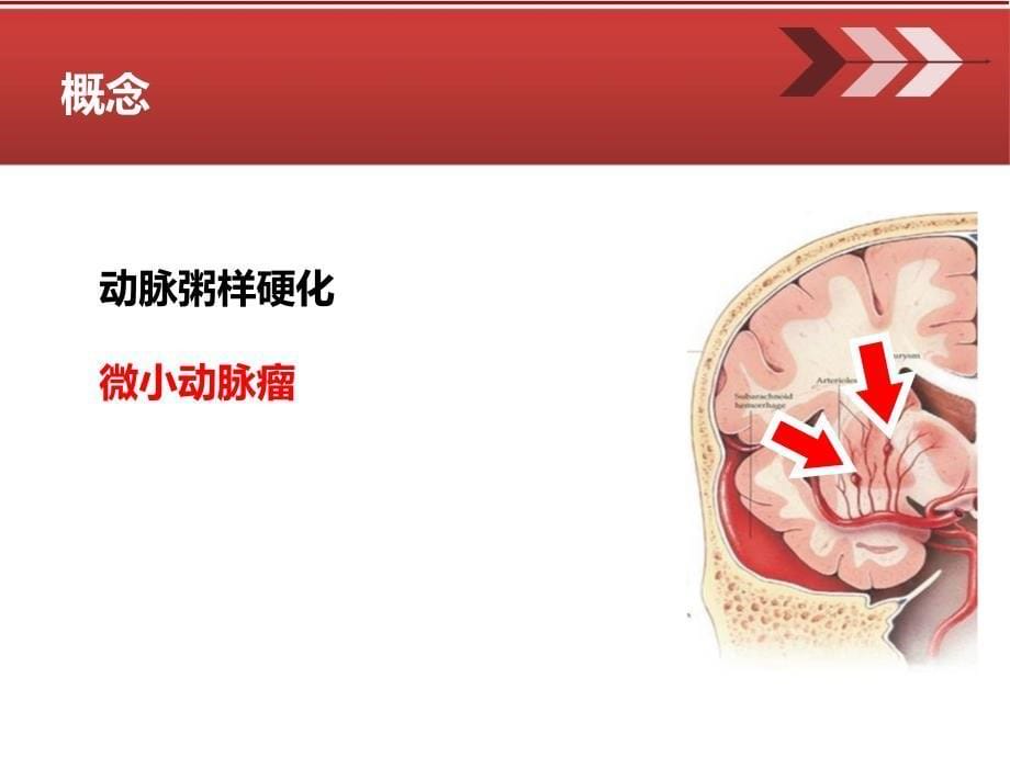 高血压脑出血围手术期护理_第5页