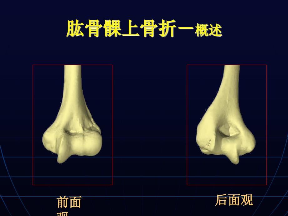 肱骨髁上外髁内上髁骨折_第3页