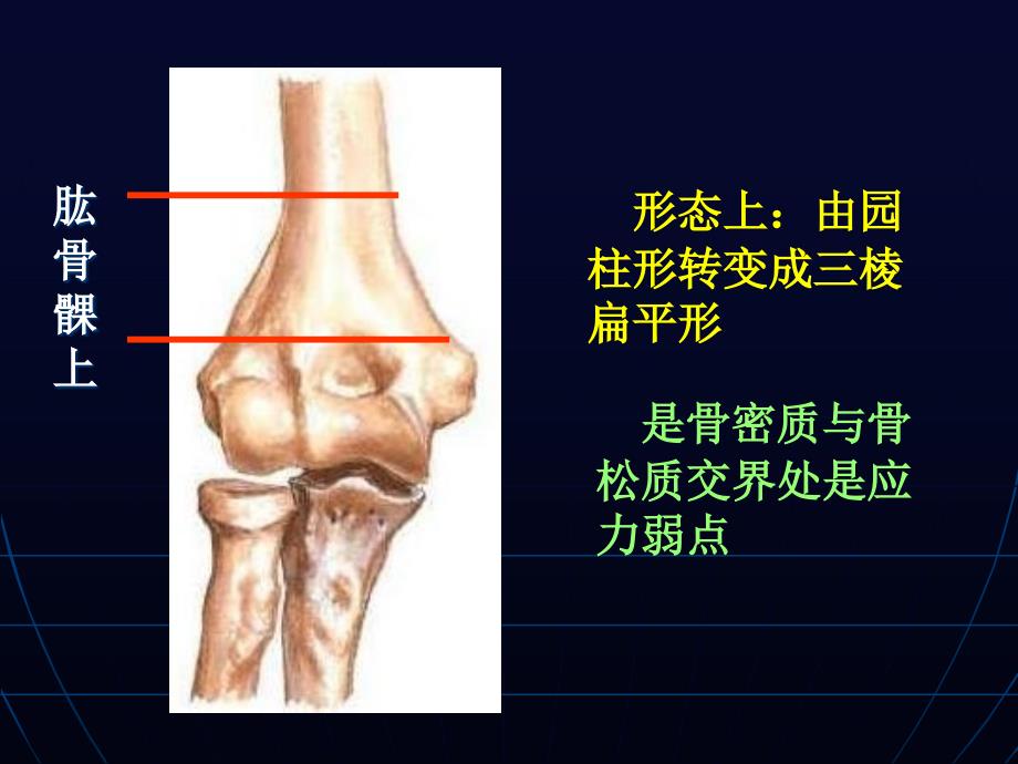 肱骨髁上外髁内上髁骨折_第4页