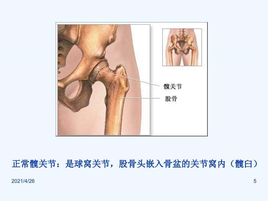 图解髋关节置换术_第5页