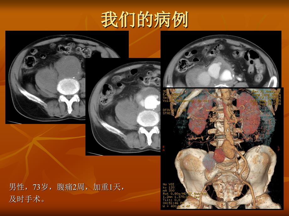 腹主动脉瘤破裂及先兆破裂的CT表现_第2页