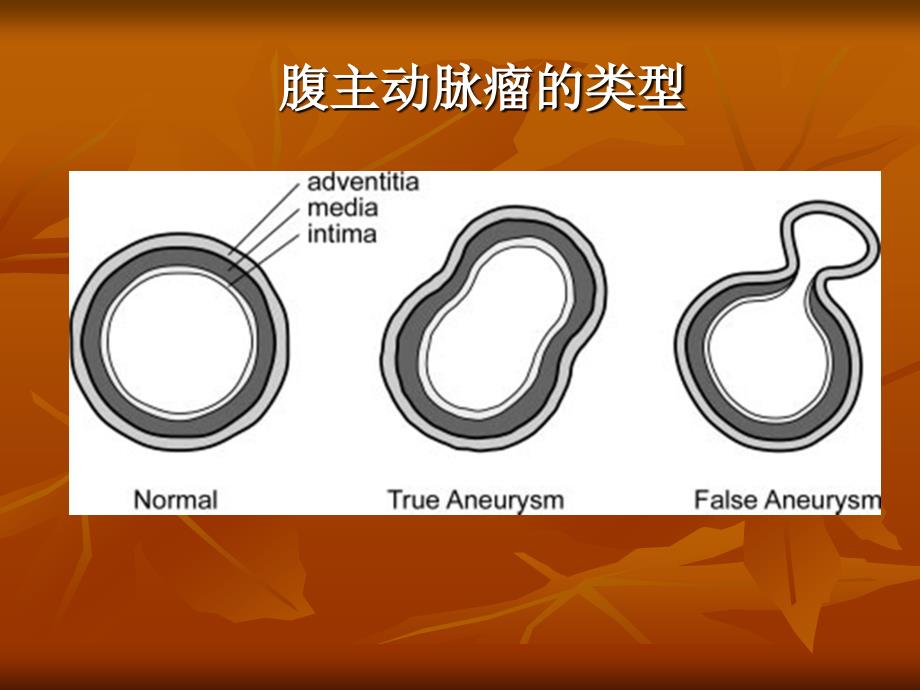 腹主动脉瘤破裂及先兆破裂的CT表现_第4页