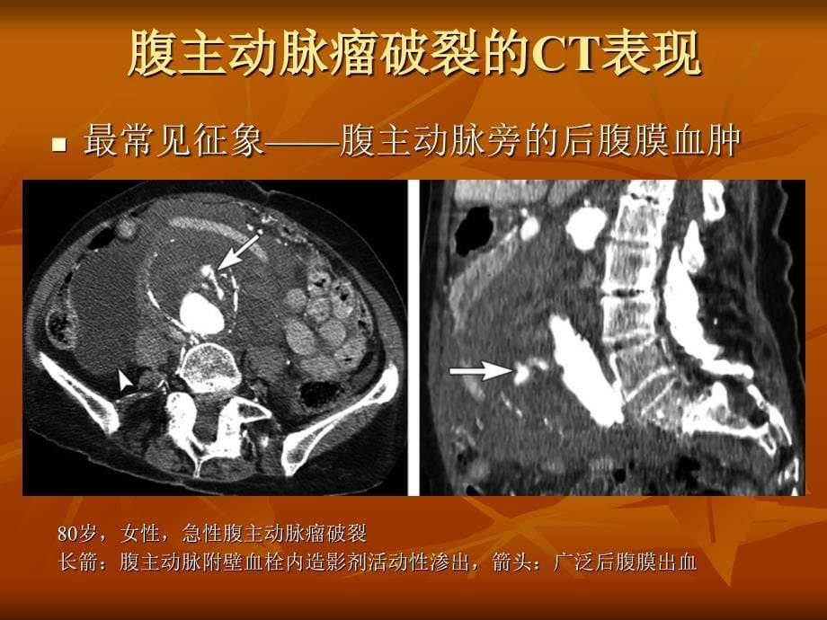 腹主动脉瘤破裂及先兆破裂的CT表现_第5页