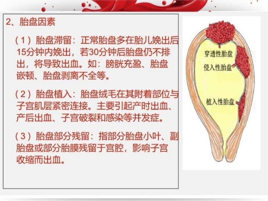 产后出血讲解学习_第5页