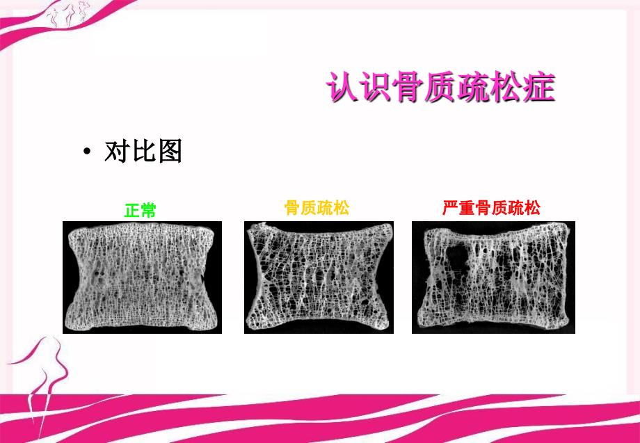 骨质疏松症概论课件_第4页