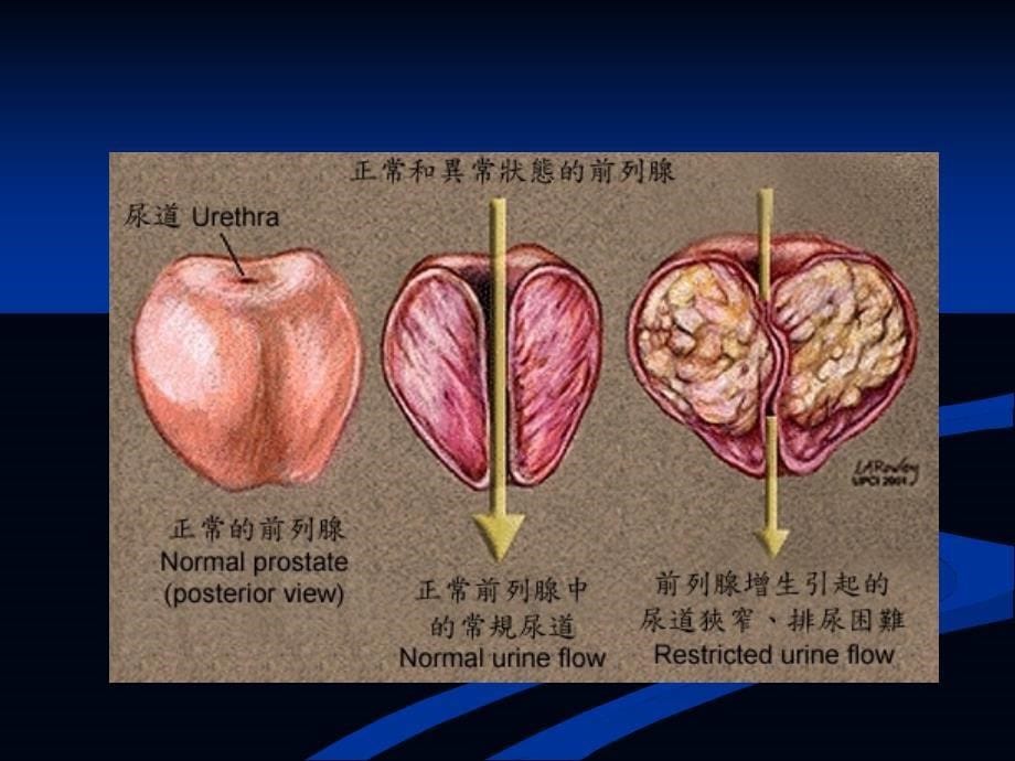 良性前列腺增生病人的护理-课件_第5页