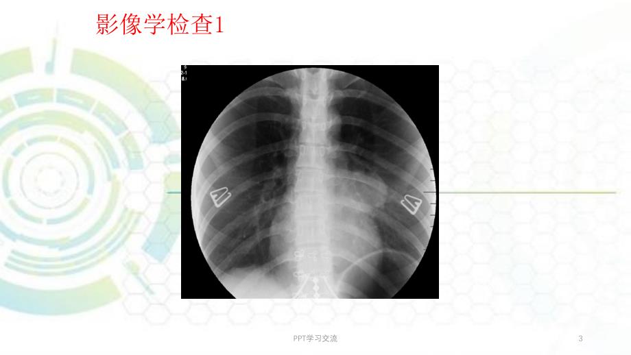 肺硬化性血管瘤ppt课件_第3页