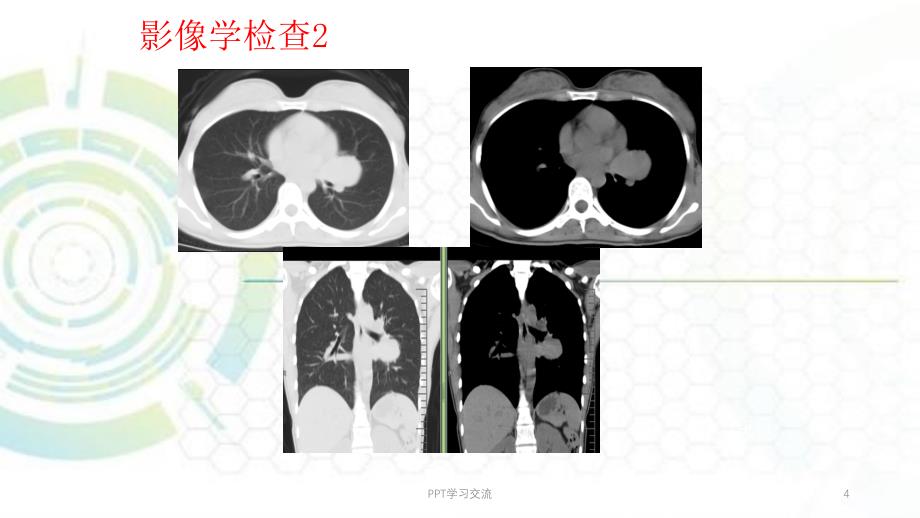 肺硬化性血管瘤ppt课件_第4页