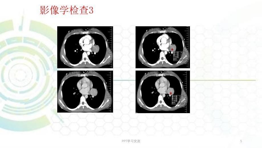 肺硬化性血管瘤ppt课件_第5页