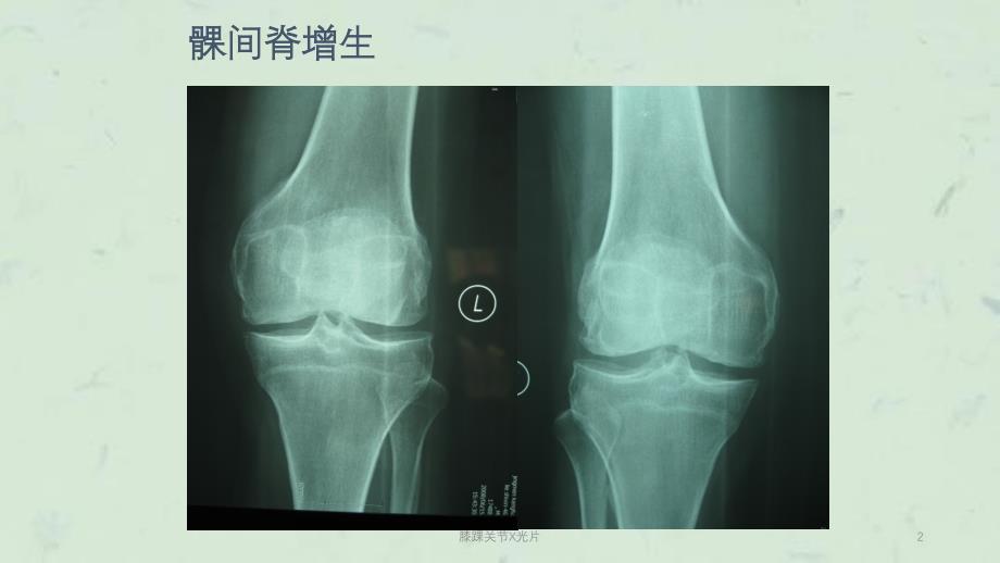 膝踝关节X光片课件_第2页