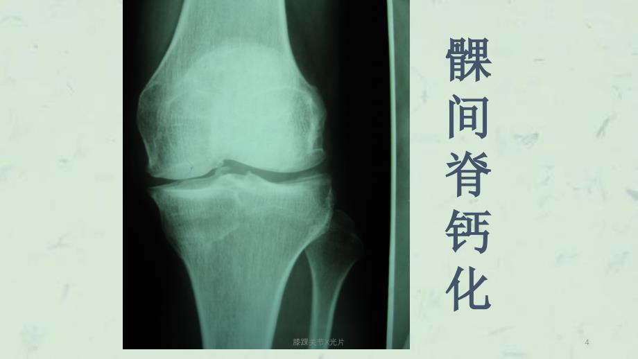 膝踝关节X光片课件_第4页