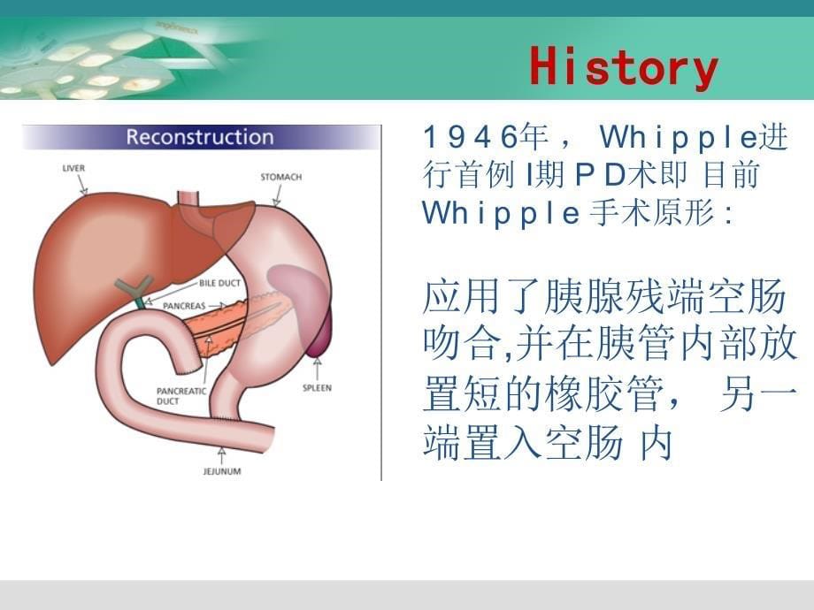 胰肠吻合方式_第5页