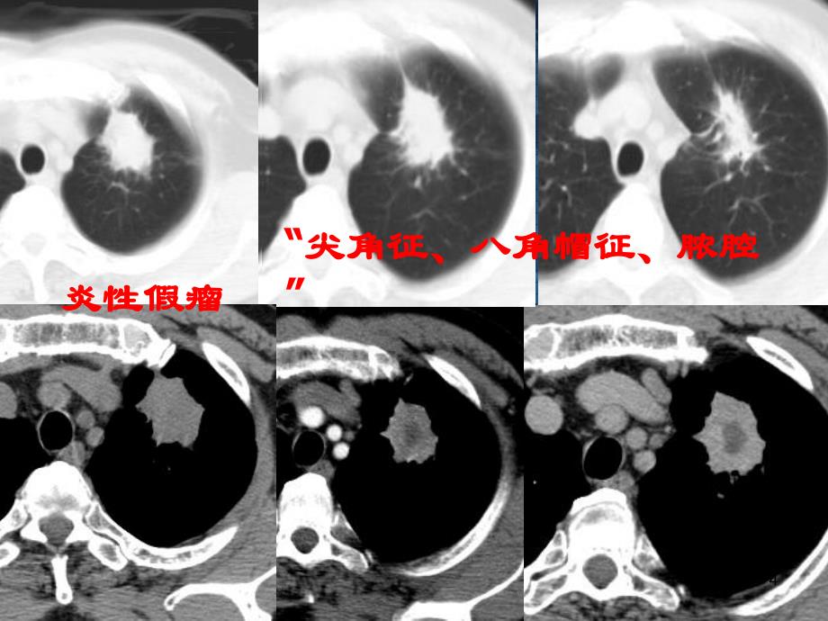 肺部结节的鉴别诊断ppt课件_第4页