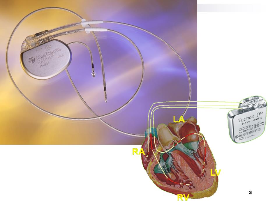 医学PPT课件心脏起搏器护理查房_第3页