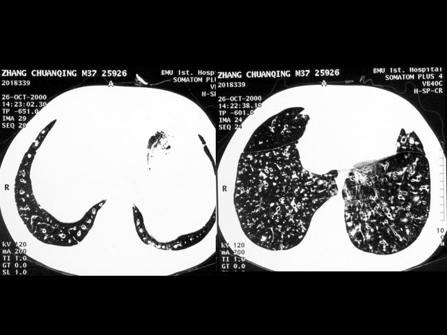 特殊征象HRCT与病理.ppt_第5页