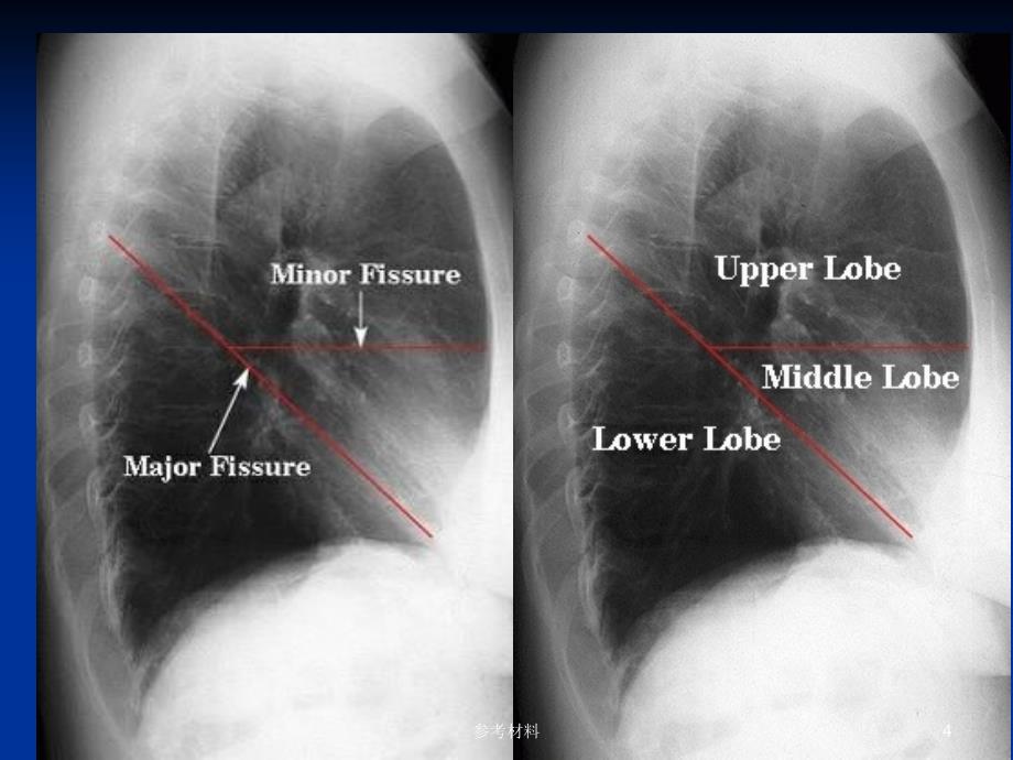 肺分段肺的分叶分段内容详析_第4页