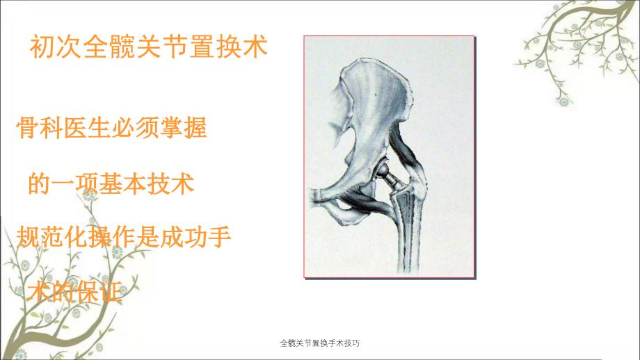 全髋关节置换手术技巧_第2页