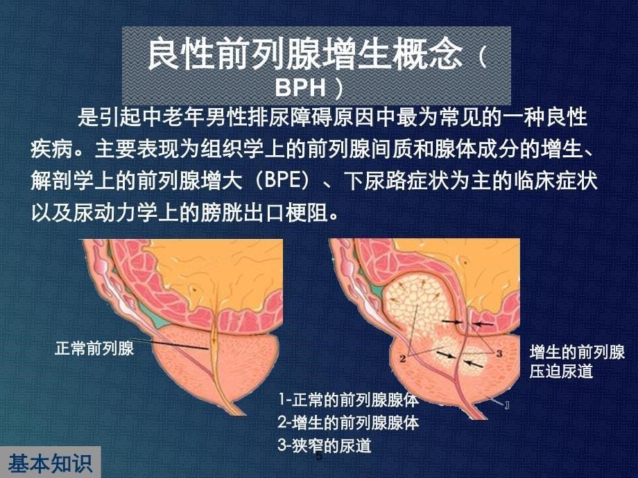 【医学ppt课件】中国良性前列腺增生症诊治指南解读_第5页